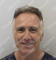 After hair transplant After hair transplant