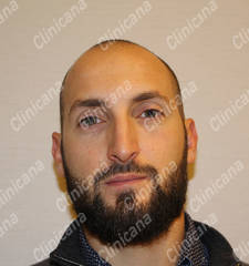 Before hair transplant Before hair transplant
