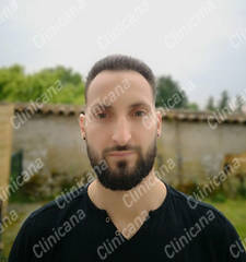 After hair transplant After hair transplant