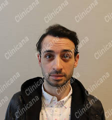 After hair transplant After hair transplant