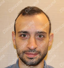 Before hair transplant Before hair transplant