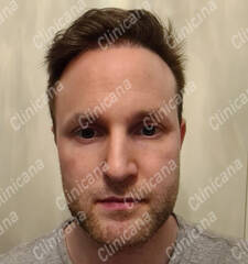 After hair transplant After hair transplant