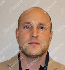 Before hair transplant Before hair transplant