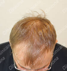 Before hair transplant Before hair transplant