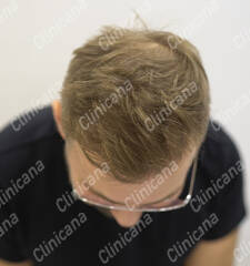 After hair transplant After hair transplant
