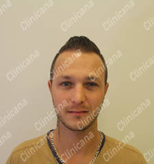 After hair transplant After hair transplant