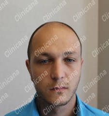 Before hair transplant Before hair transplant