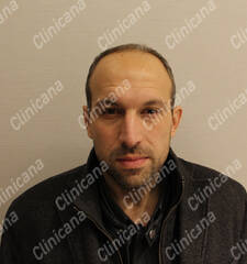 Before hair transplant Before hair transplant