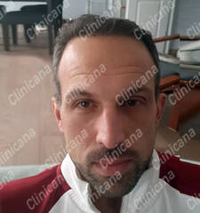 After hair transplant After hair transplant