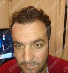 Before hair transplant Before hair transplant