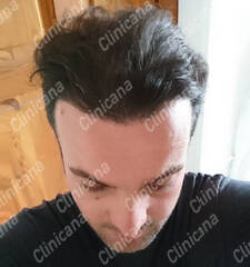 After hair transplant After hair transplant